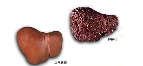 【危害】肝硬化的危害有多大?